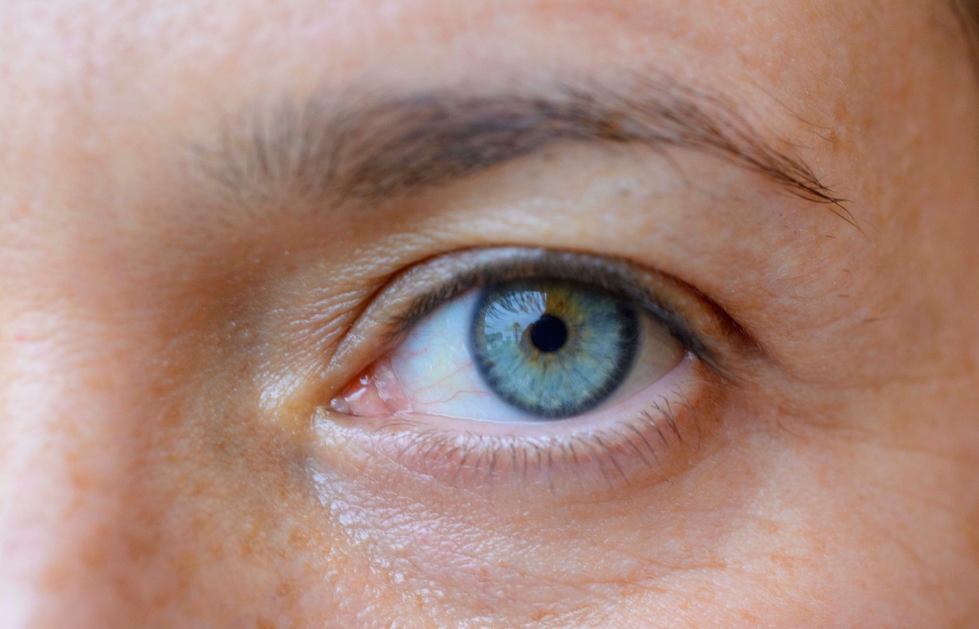 Common Eye Disorders