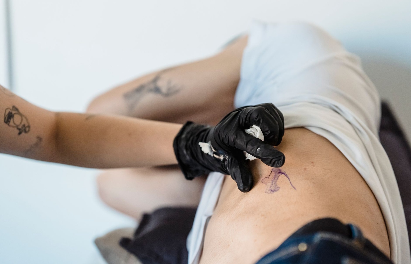 Dry Needling